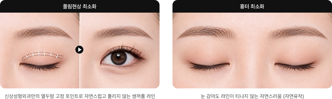 Minimizes line loosening — SINSANG Plastic Surgery's own 12-stitch fixation points for a natural double eyelid line that doesn't come undone / Minimizes scarring — so natural the line doesn't show even with eyes closed (natural adhesion)