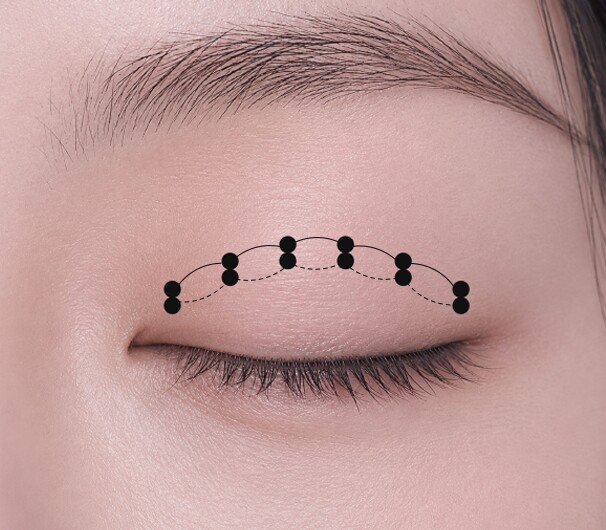 Delicate Suturing