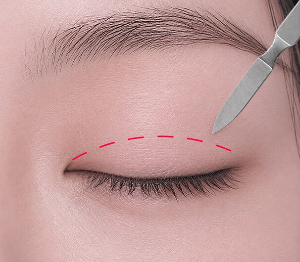 Minimal Incision