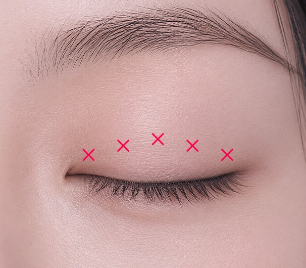 Precise Suturing