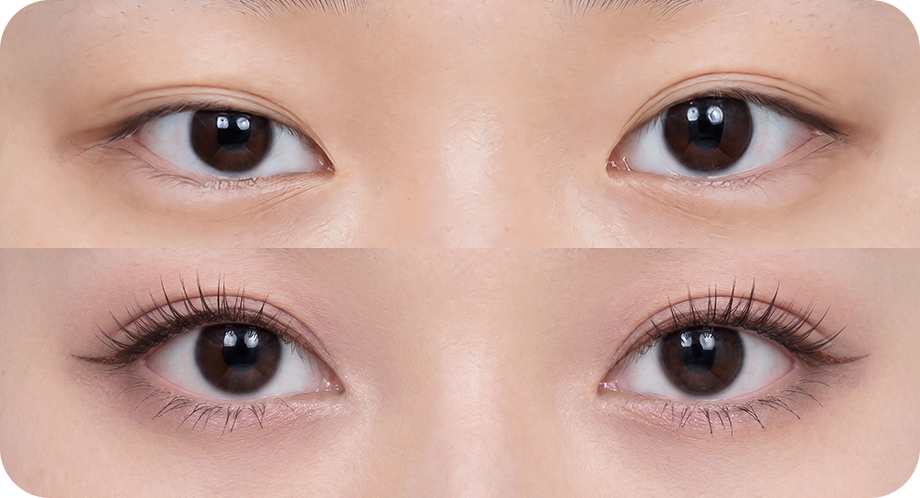 CASE 02 When the double eyelid line has come undone