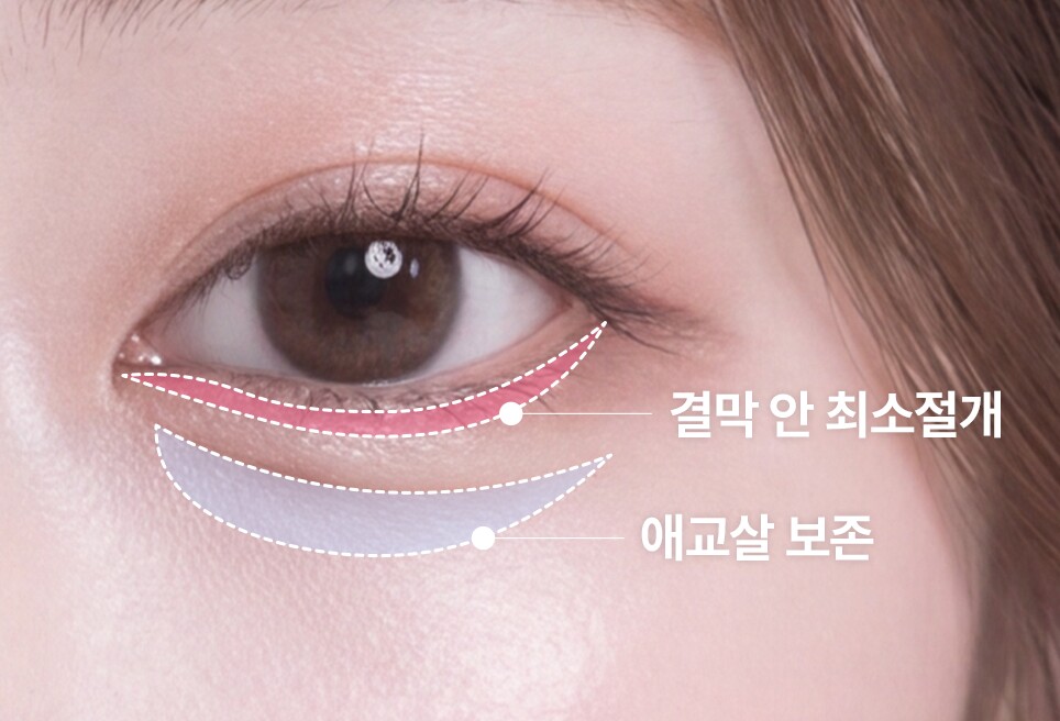 Minimal incision inside the conjunctiva · aegyo-sal preservation