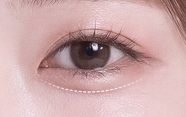 Customized minimal incision