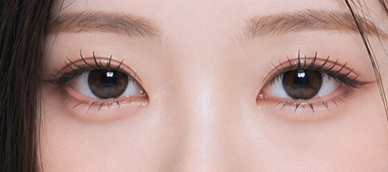 Under-Eye Fat Repositioning