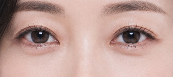 Lower Blepharoplasty