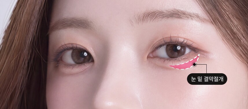 step 01 Incision in the inner conjunctiva under the eye