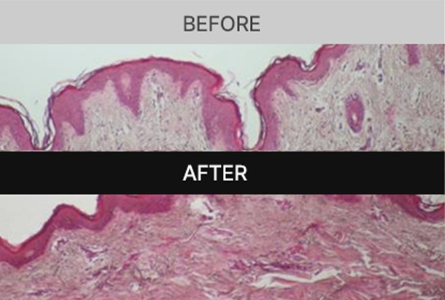 BEFORE AFTER skin tissue comparison