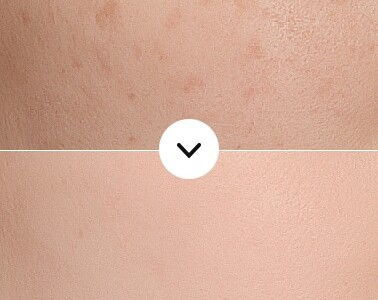 Before and after improvement of superficial blemishes