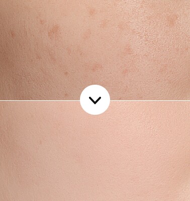 Before and after improvement of superficial blemishes