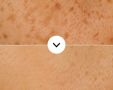 Before and after vascular melasma