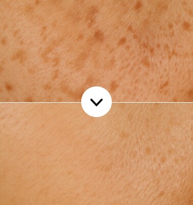 Before and after vascular melasma