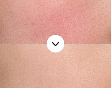 Before and after combined redness + pigmentation