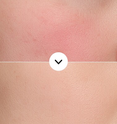 Before and after combined redness + pigmentation