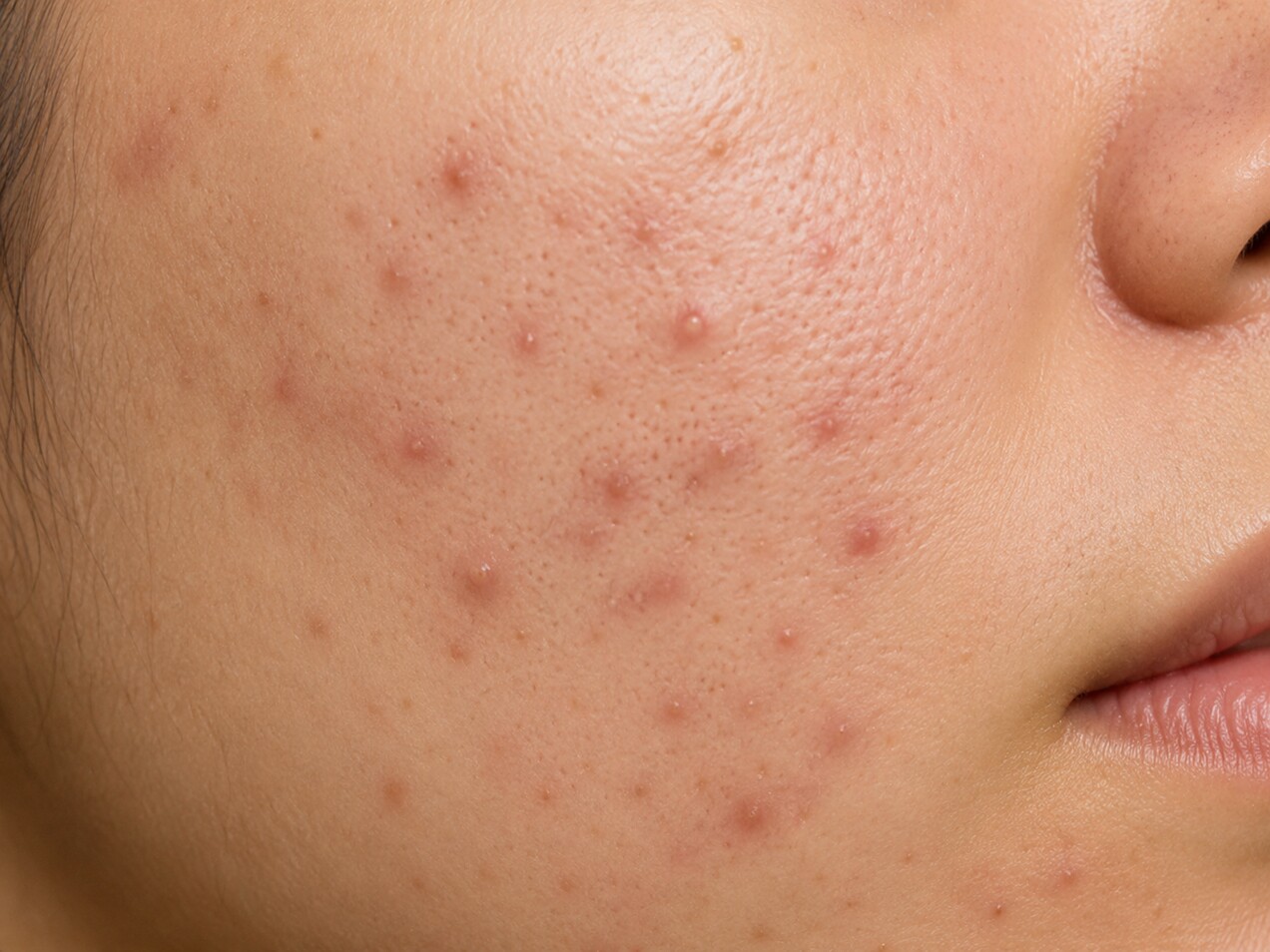 Acne Scars