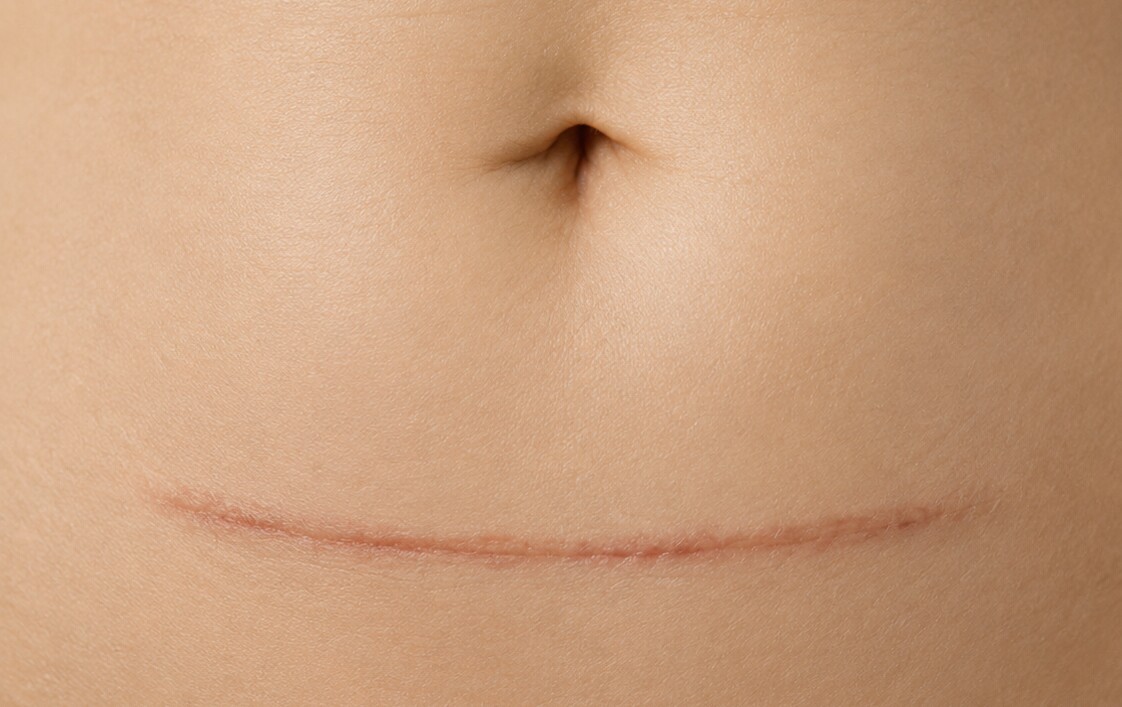 Surgical Scars