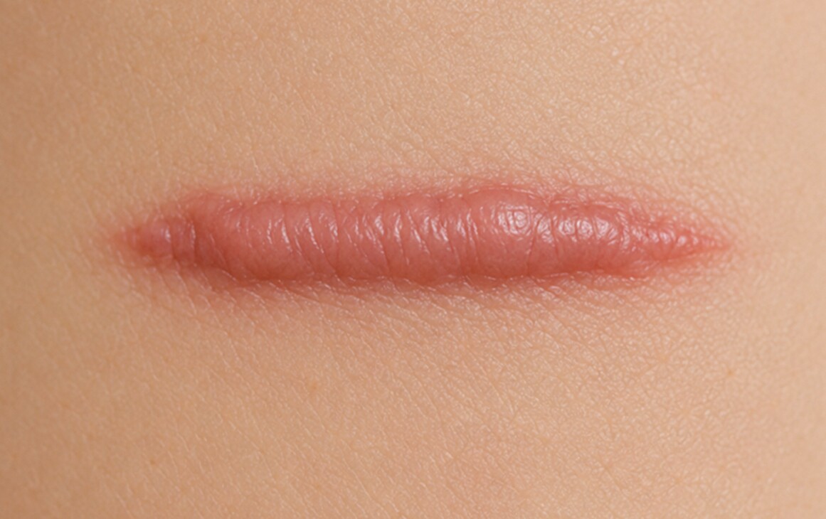 Keloid Scars