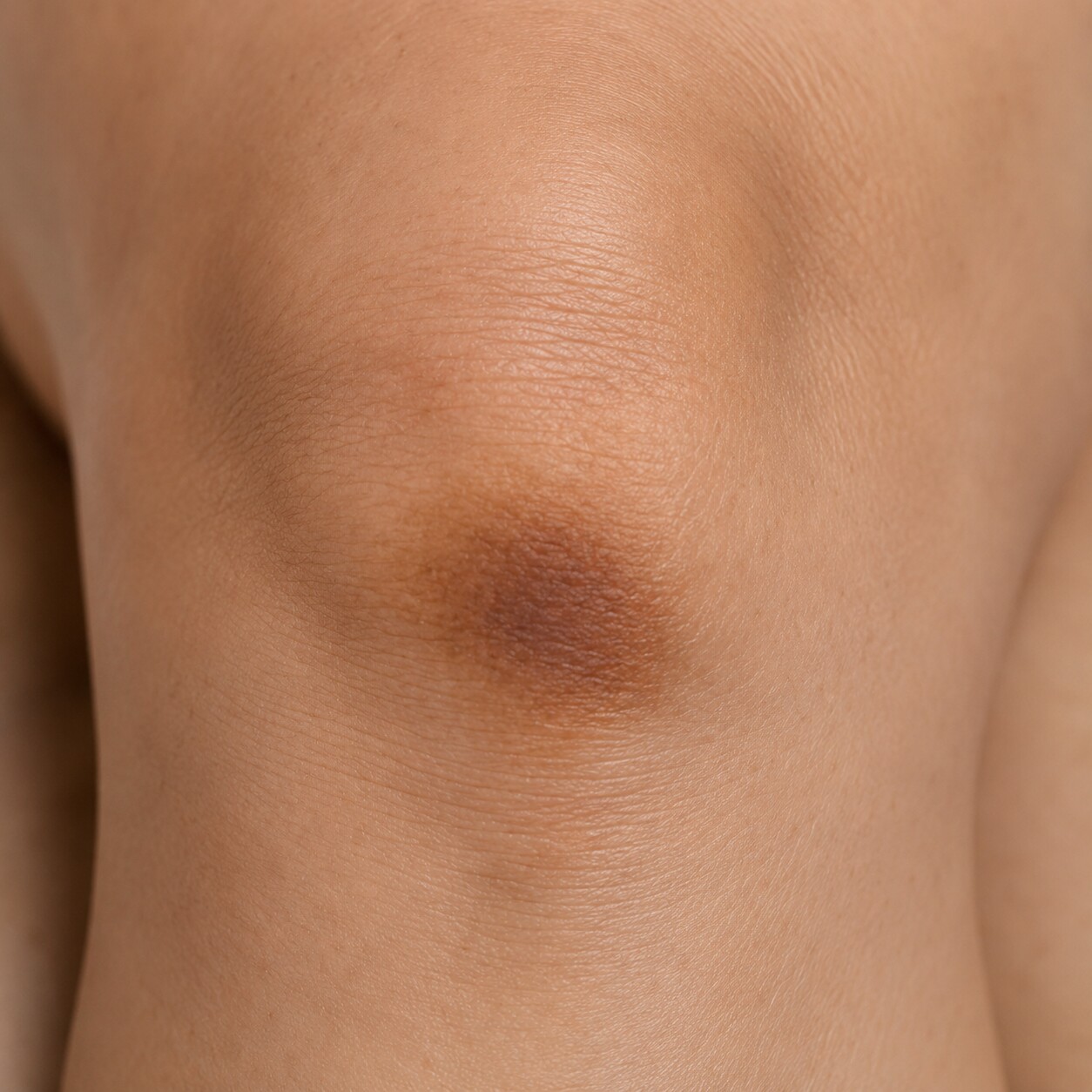 Pigmented Scars