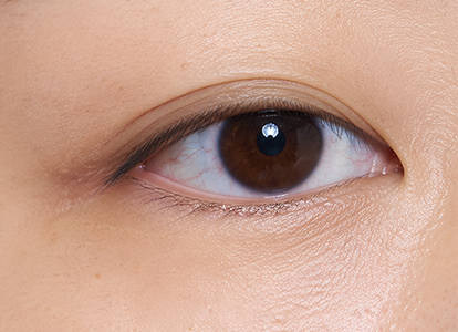 After eyeliner tattoo removal
