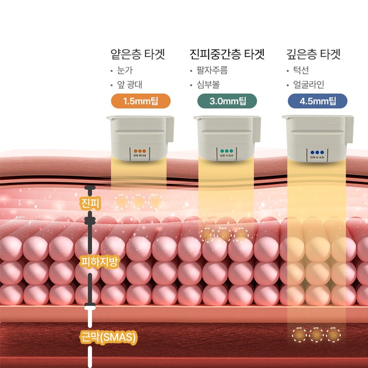 1.5mm tip (targets thin layer: around the eyes, front cheekbones) · 3.0mm tip (targets mid-dermis: nasolabial folds, deep cheeks) · 4.5mm tip (targets deep layer: jawline, facial line)