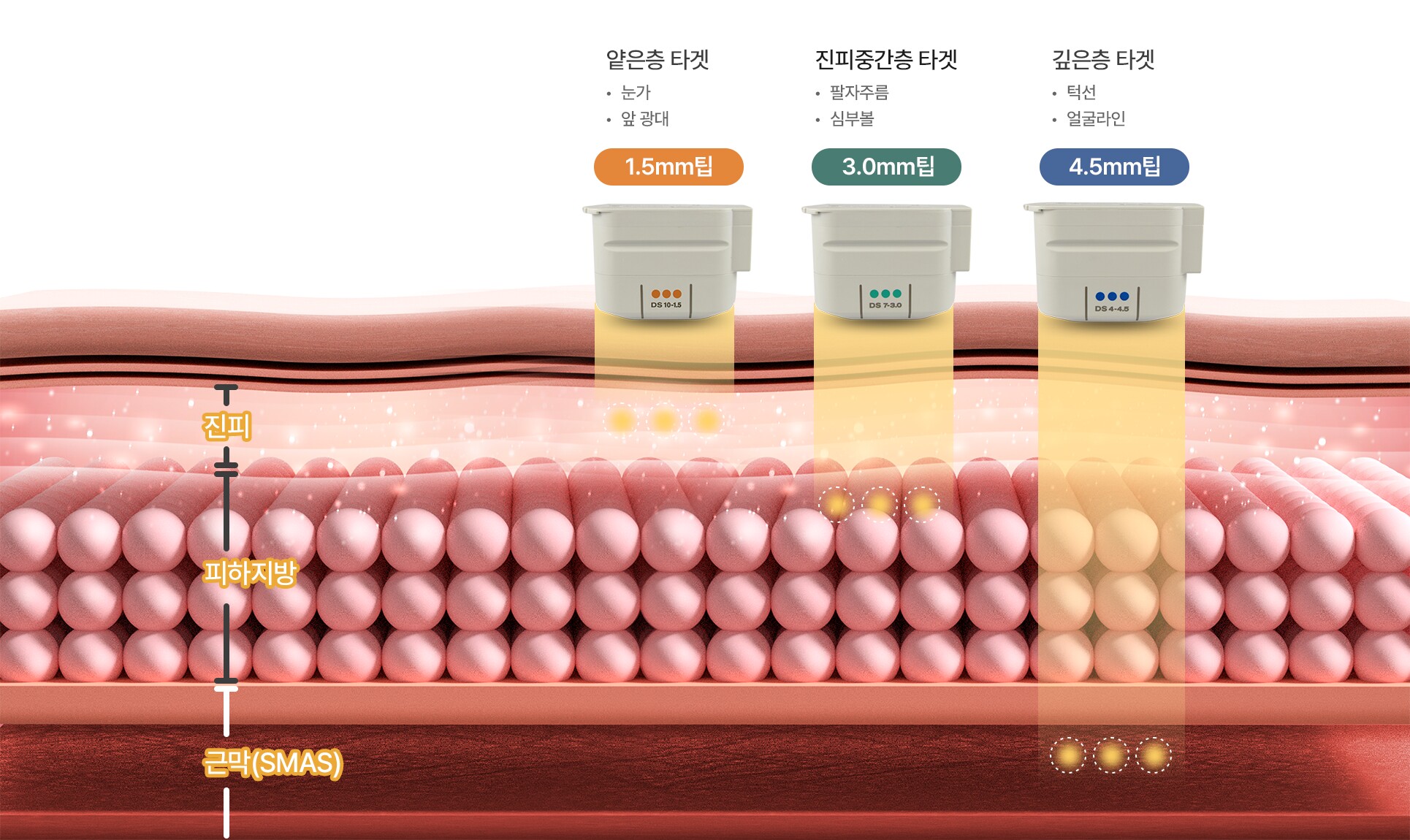 1.5mm tip (targets thin layer: around the eyes, front cheekbones) · 3.0mm tip (targets mid-dermis: nasolabial folds, deep cheeks) · 4.5mm tip (targets deep layer: jawline, facial line)
