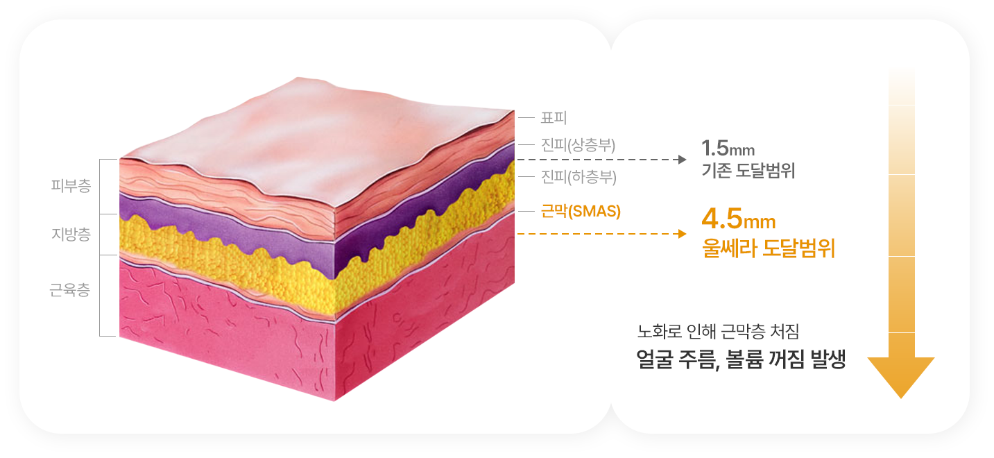 Reach into epidermis, dermis and fascia (SMAS) — conventional 1.5mm, Ulthera 4.5mm
