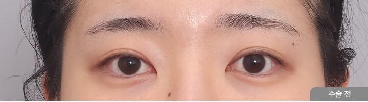 First Eye Surgery + Ptosis Correction, front view, before surgery
