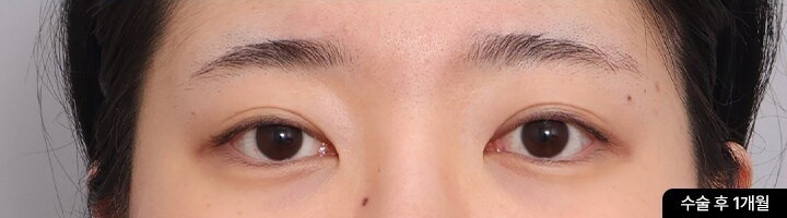 First Eye Surgery + Ptosis Correction, front view, after surgery