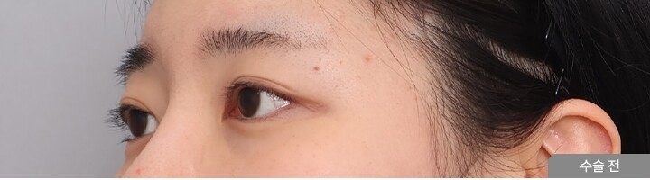 First Eye Surgery + Ptosis Correction, 45-degree view, before surgery