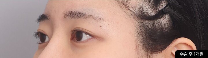 First Eye Surgery + Ptosis Correction, 45-degree view, after surgery