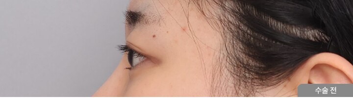 First Eye Surgery + Ptosis Correction, side view, before surgery