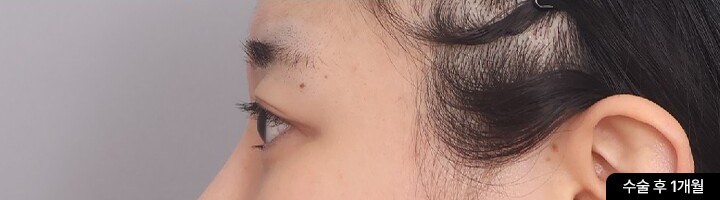 First Eye Surgery + Ptosis Correction, side view, after surgery