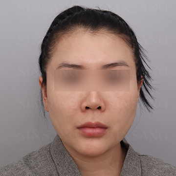 Cheekbone Reduction + Square Jaw Reduction + Chin, front view, before surgery