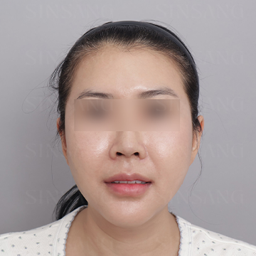 Cheekbone Reduction + Square Jaw Reduction + Chin, front view, after surgery