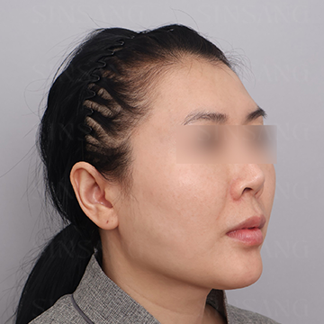 Cheekbone Reduction + Square Jaw Reduction + Chin, 45-degree view, before surgery
