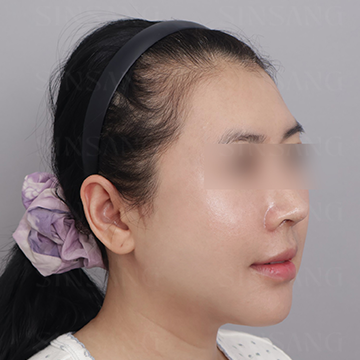 Cheekbone Reduction + Square Jaw Reduction + Chin, 45-degree view, after surgery