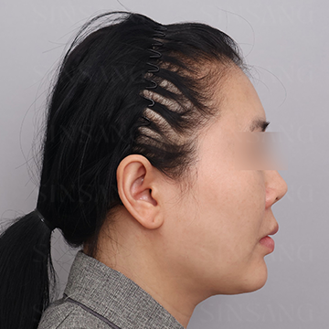 Cheekbone Reduction + Square Jaw Reduction + Chin, side view, before surgery