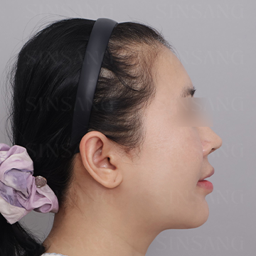 Cheekbone Reduction + Square Jaw Reduction + Chin, side view, after surgery
