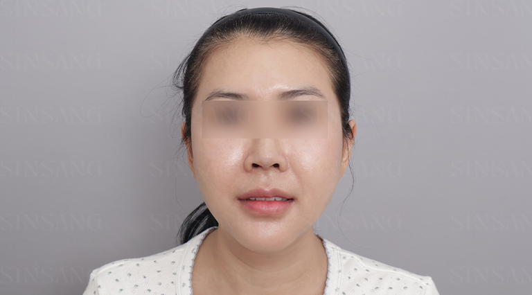 Cheekbone Reduction + Square Jaw Reduction + Chin before & after photos
