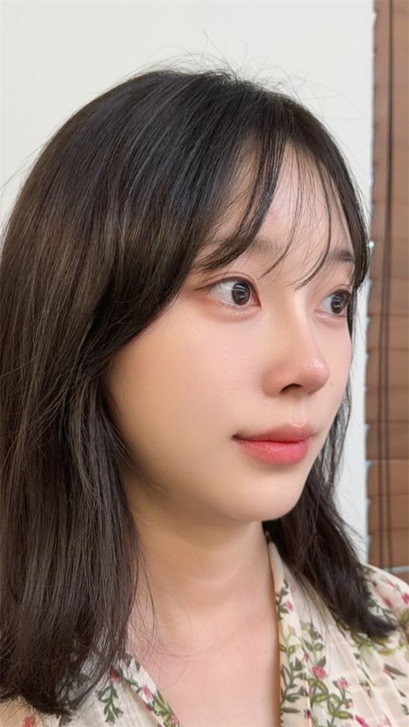 Rhinoplasty